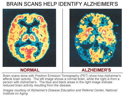 Two parents with AlzheImer's disease? Disease may show up decades early on brain scans